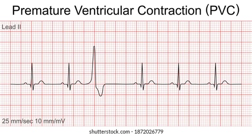 Premature Ventricular Contractions (PVC)